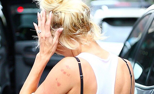 What Are The Marks on Pamela's Anderson Arms